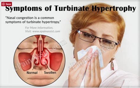 Inflamed Nasal Turbinates