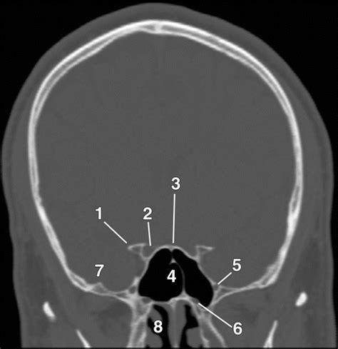 Foramen Rotundum Xray