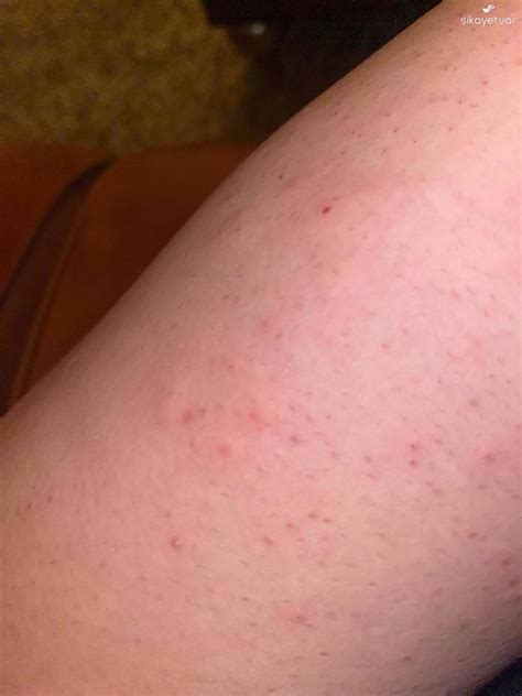 Severe Allergic Reaction After Using Veet Men Sensitive Skin Hair