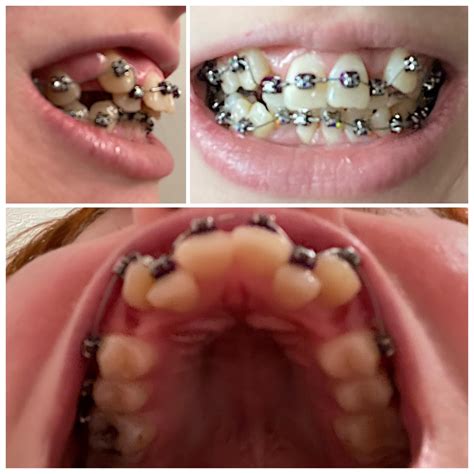 power chains  progress rbraces