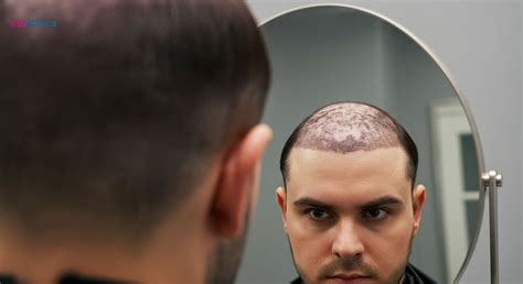 unlock confidence hair transplant insights revealed