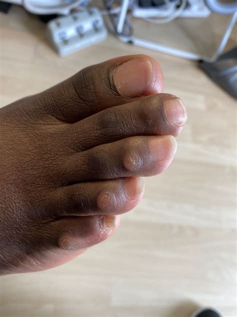 Todays Toe Lift Stage 1 Patient