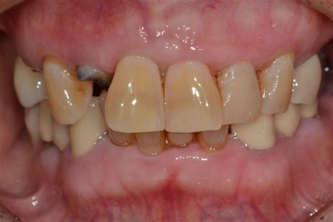 임플란트 보철 시기 및 종류 - Good Dental Clinic
