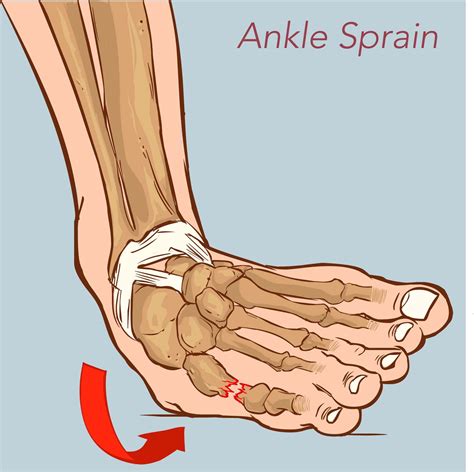 Illustration Showing A Sprained Ankle Ankle Sprain Symptoms Sprained ...