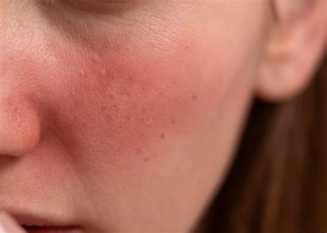 rosacea poms med spa