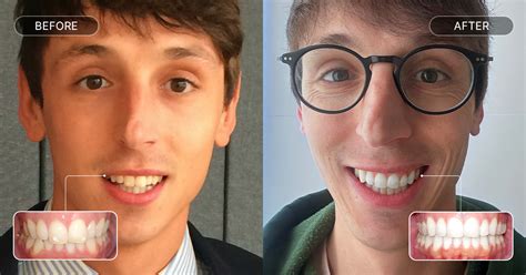 overbite      treatments