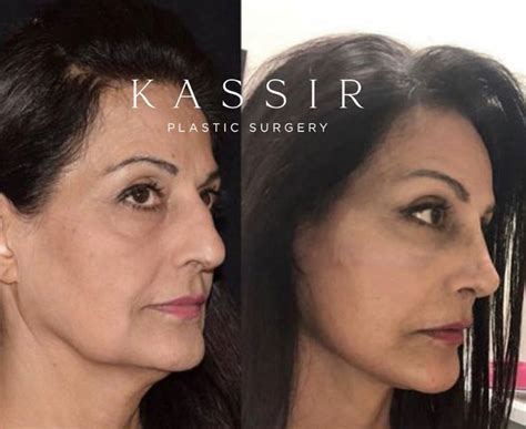 Discover the Mini Facelift: Cost, Before and After, and More — Kassir ...