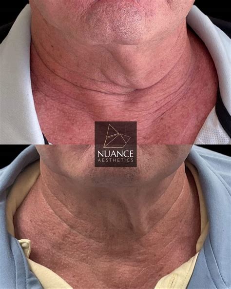 Coolsculpting Face - Nuance