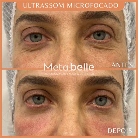 O Que É Ultrassom Microfocado - Ultrassom Microfocado – Metabelle