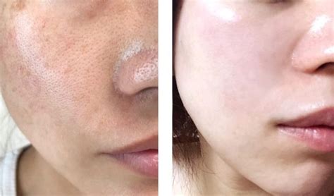 Dr derm skin results with before after pictures – Artofit