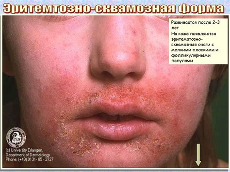Атопический дерматит - презентация онлайн