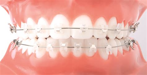 Orthodontics Braces Doctor, Orthodontics Diagnosis, Best Orthodontics