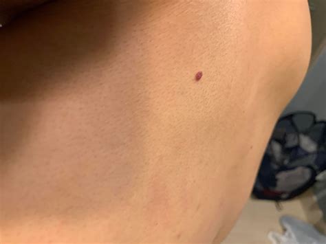 Nodular melanoma? : r/Melanoma