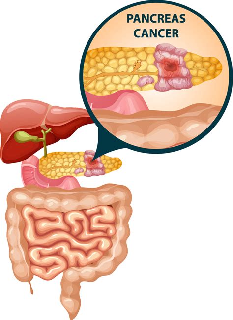 pancreatic cancer symptoms   treatments options