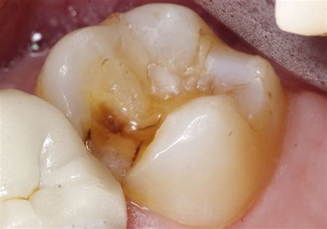 composite restorations steve  kim dds