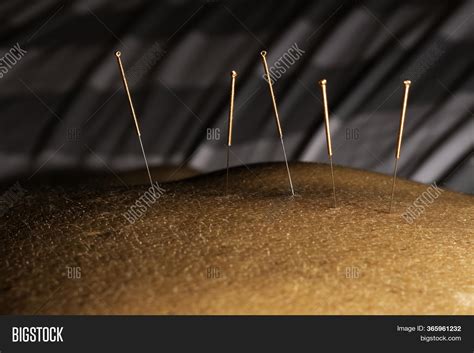 Acupuncture Needles Image & Photo (Free Trial) | Bigstock