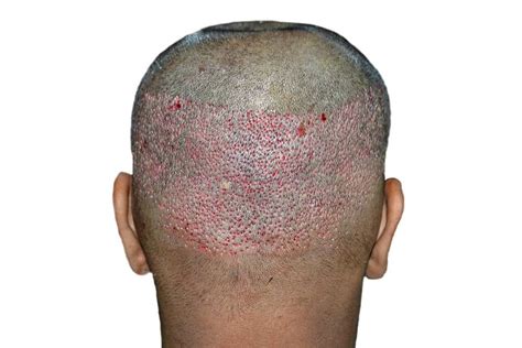 7 Hair Transplant Side Effects And Risks You Should Know