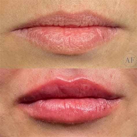 lip filler treatmentsservices