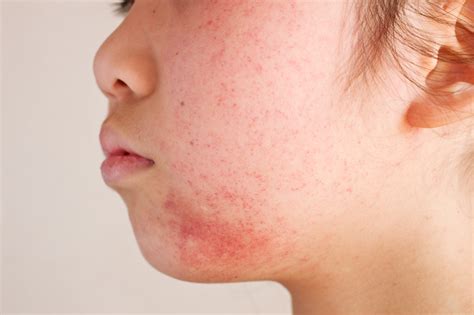 Dermatitis Treatment | U.S. Dermatology Partners