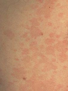 skin infections treatment  singapore stratum skin  surgery