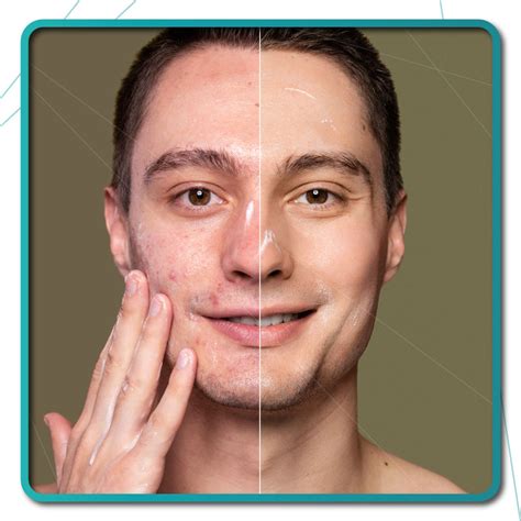 photo rejuvenation mary beauty clinic