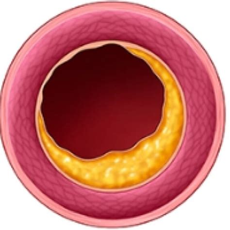 vascular ring stent wikimedia commons   encyclopedia