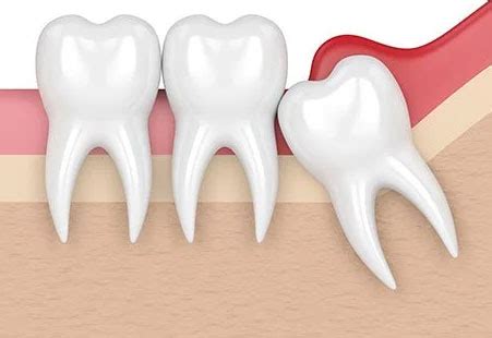 pericoronitis     symptoms treatments