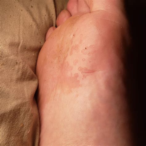 Red spots on bottom of feet. Who think what? : r/medical