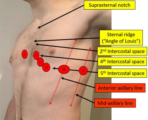 proper electrocardiogram ecgekg lead placement ecgedu