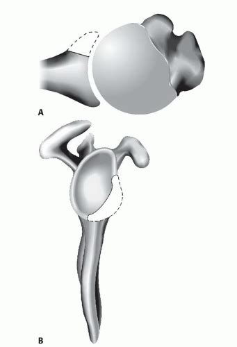 glenoid bone graft  instability  bone loss musculoskeletal key