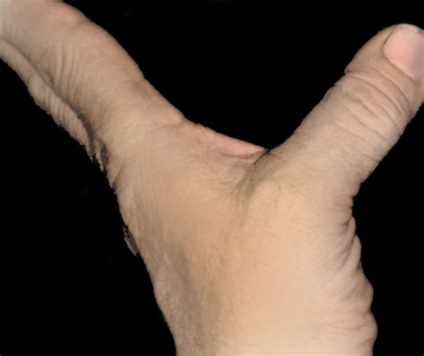 Sprained Thumb Causes, Symptoms, and Effective Treatment