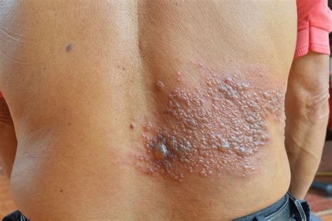 Herpes No Corpo E Contagioso - Herpes zóster: o que é, sintomas, causas e tratamento - Tua Saúde