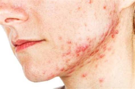 Espinhas Na Região Do Queixo - Descubra as causas das espinhas em cada parte do corpo – GosteiSalvei