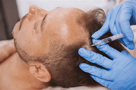 PRP For Hair Loss: How to Treat Hair Loss Long-Term - The Derm ...