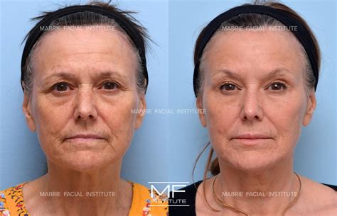 how to prevent forehead wrinkles 13