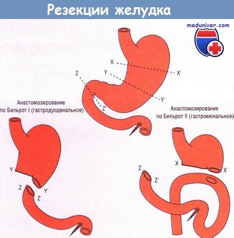 Показания к операции по Billroth I. Техника резекции желудка по Billroth I.