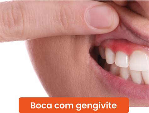Tenho Gengivite E Beijei Um Soropositivo - Gengivite: quais as causas e o tratamento? - Sorriso Mais