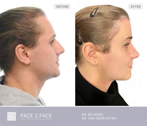 hairline lowering facial feminization surgery faceface clinic