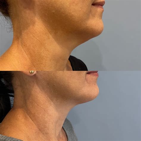 thread lift caringbah wollongong