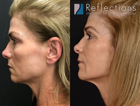 NonSurgical Facelift with Thread Lift & Fillers Before & After Photos ...