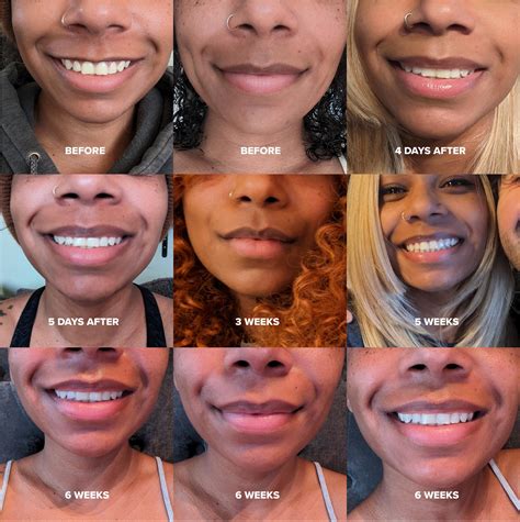 Lip Botox Before And After