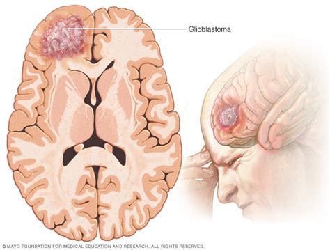 Glioblastoma: The Deadliest Brain Tumor – Youth Medical Journal
