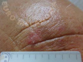 Actinic keratosis - Euromelanoma