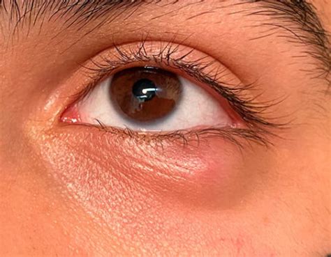 Chalazion | Oculoplastia - Dra. Carla Varallo