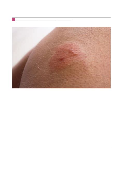 Pelo De Aranha Na Pele Como Tratar - Como tratar picadas de insetos e picadas de aranha - Clínica Médica I