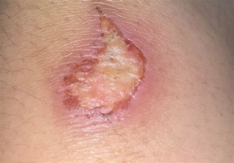 guide  hypergranulation tissue pictures  effective wound care