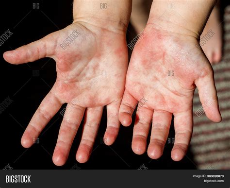 Red Rash On Hands Image & Photo (Free Trial) | Bigstock