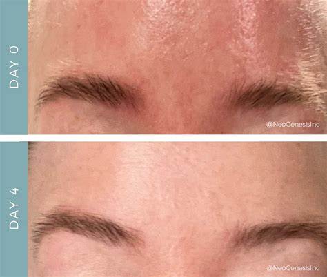 perioral dermatitis forehead  started  perioral dermatitis