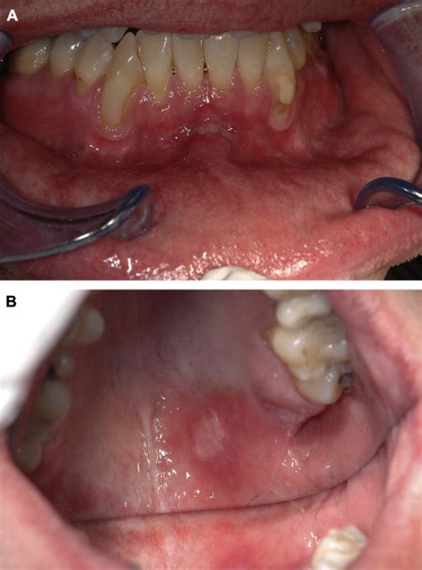 Gonorrhea Lips Symptoms | Lipstutorial.org