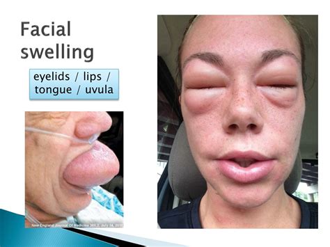 PPT - Anaphylaxis PowerPoint Presentation, free download - ID:8840544